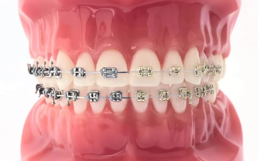 Ile trwa zakładanie aparatu stałego na górę - co musisz wiedzieć