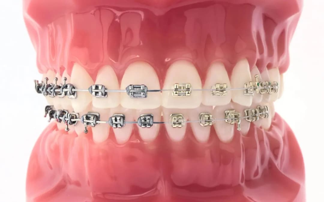 Ile trwa zakładanie aparatu stałego na górę - co musisz wiedzieć